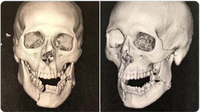 佐々木憂流迦骨折の治療代は誰が払うの？■シュウ・ヒラタのMMAマシンガントーク