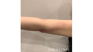 二の腕脂肪吸引の経過観察 傷跡は ダウンタイムは The Clinic 脂肪吸引のブロマガ ブロマガ