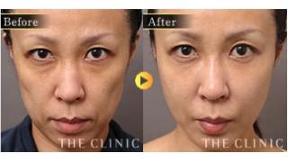 顔の脂肪注入 効果と画像 定着率を上げる方法とは The Clinic エイジングのブロマガ ブロマガ